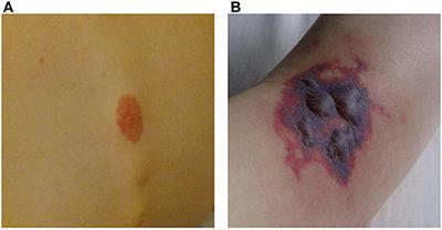 Case Report: Systemic Small-Vessel Vasculitis in an Adolescent With Active Ulcerative Colitis